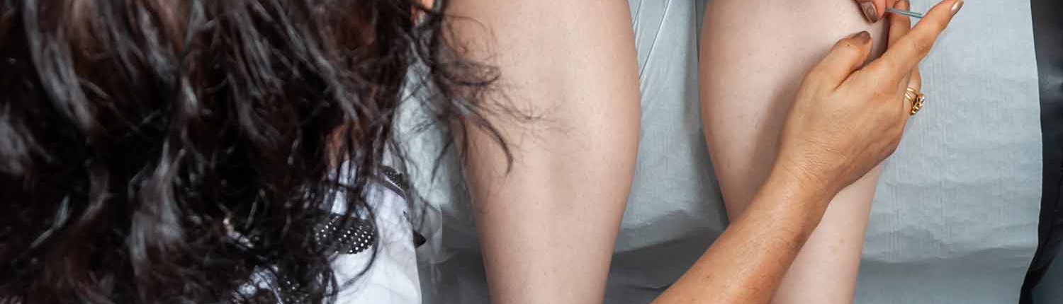 Dry Needling Acupuncture Treatment